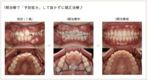 早期治療により歯を抜かずに整った症例