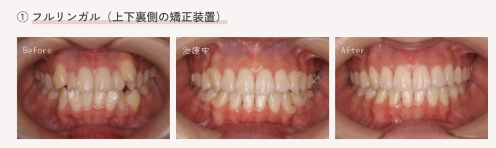 大人の裏側矯正