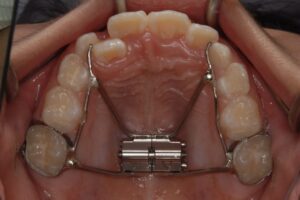 子供の急速拡大装置