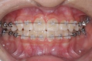 2期治療のワイヤー矯正(白い装置) 2期治療のワイヤー矯正(白い装置)