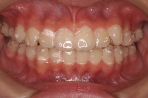 2期治療のマウスピース矯正