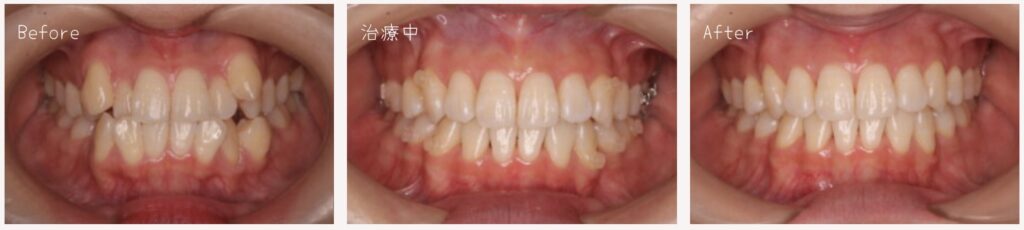 裏側矯正　装置　見え方